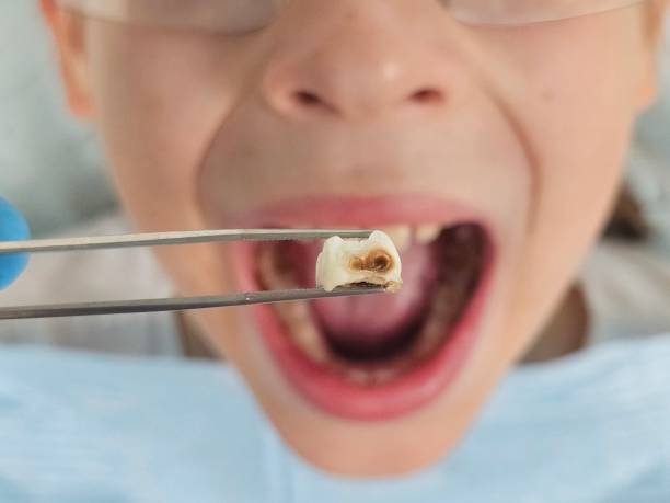 Best Broken or Cracked Tooth Emergency Dentist in Huber Heights, OH